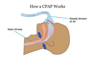 تاثیر عملکرد سی پپ در انتخاب بهترین CPAP
